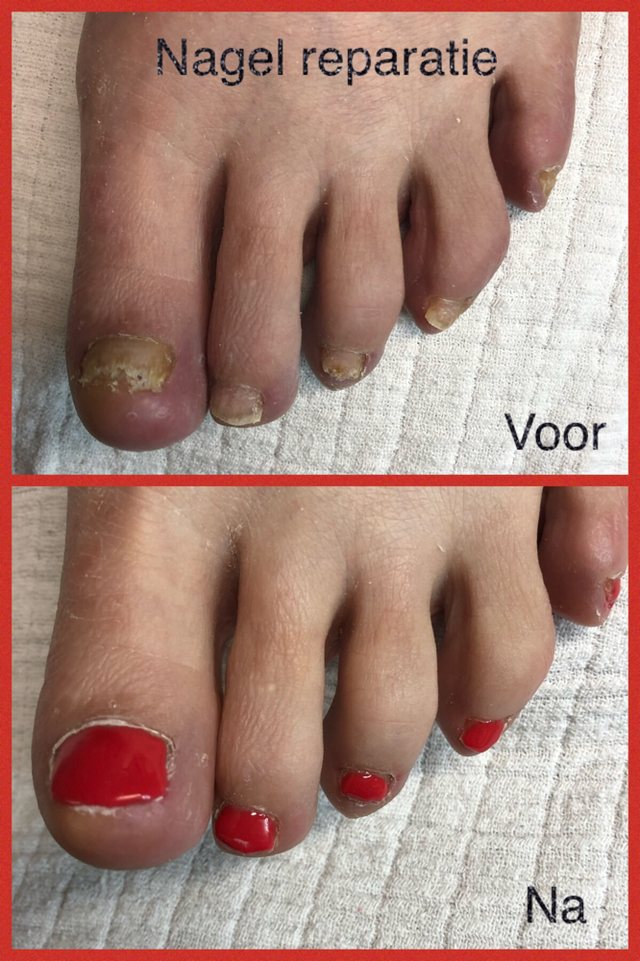 Teennagels voor en na een nagelreparatie: eerst verkleurd en beschadigd, daarna hersteld en gelakt